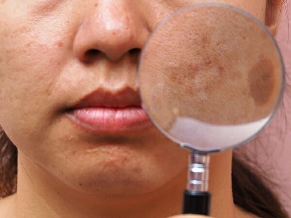Alpha Arbutin 6 alpha arbutin có tốt không