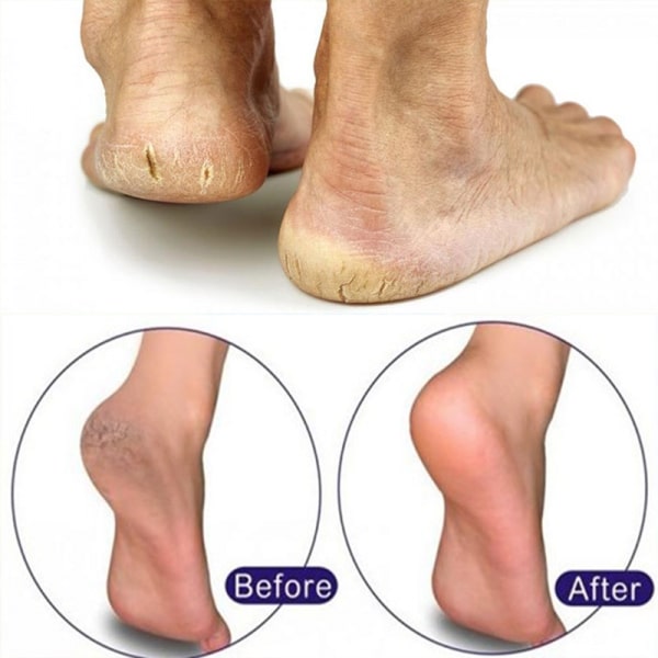 Bơ hạt mỡ 10 tác dụng của bơ hạt mỡ